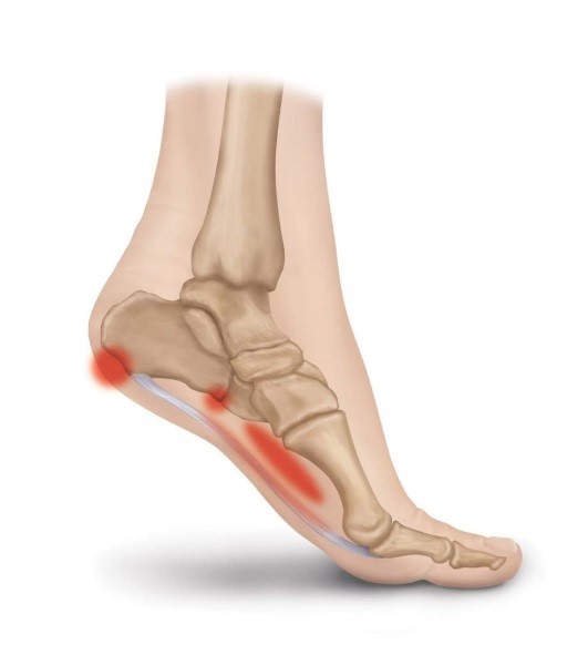 Long-Term Association of Plantar Fasciitis And Back Pain | PostureWorks  Chiropractic